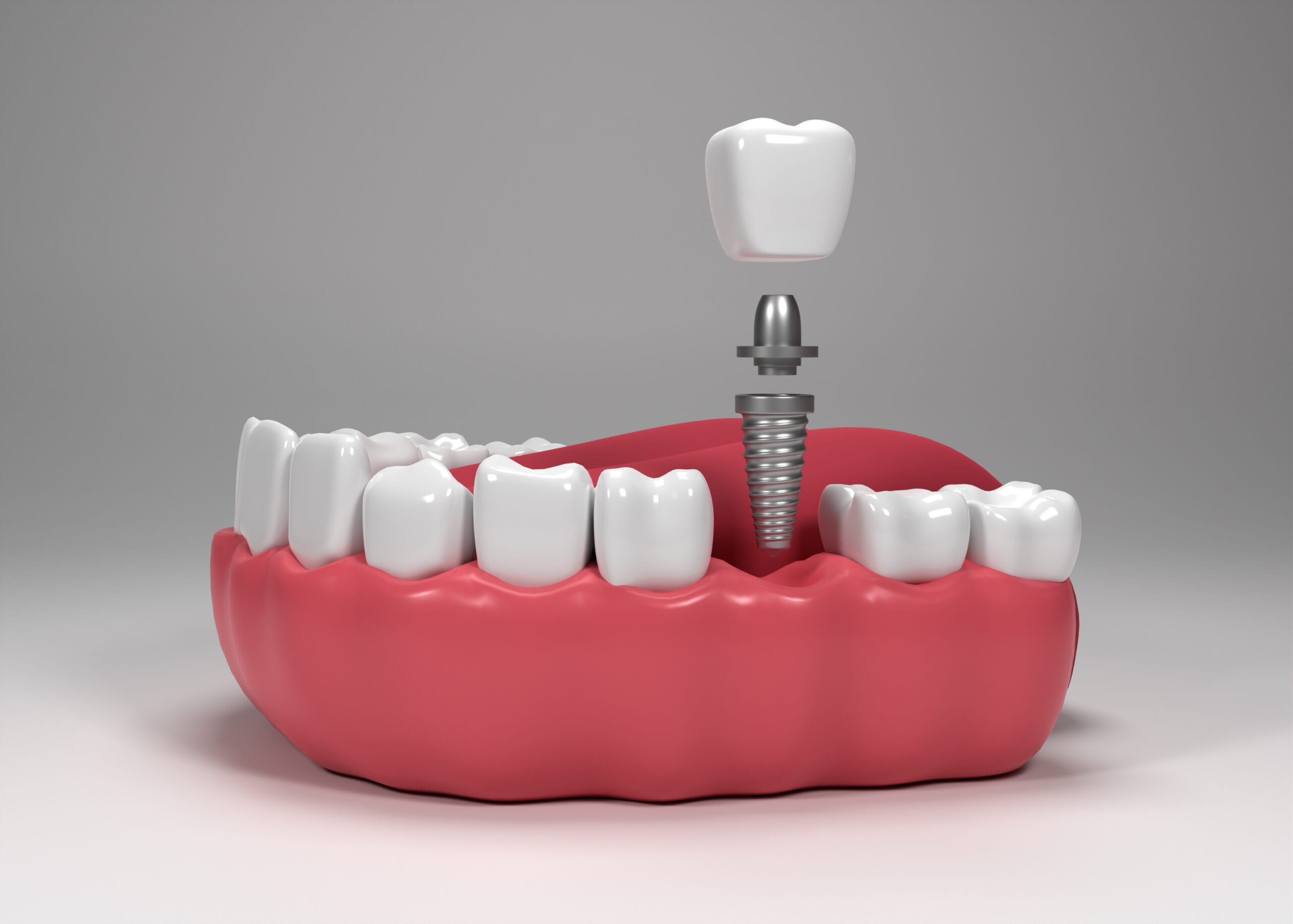 Periodontics Oral Implantology scaled
