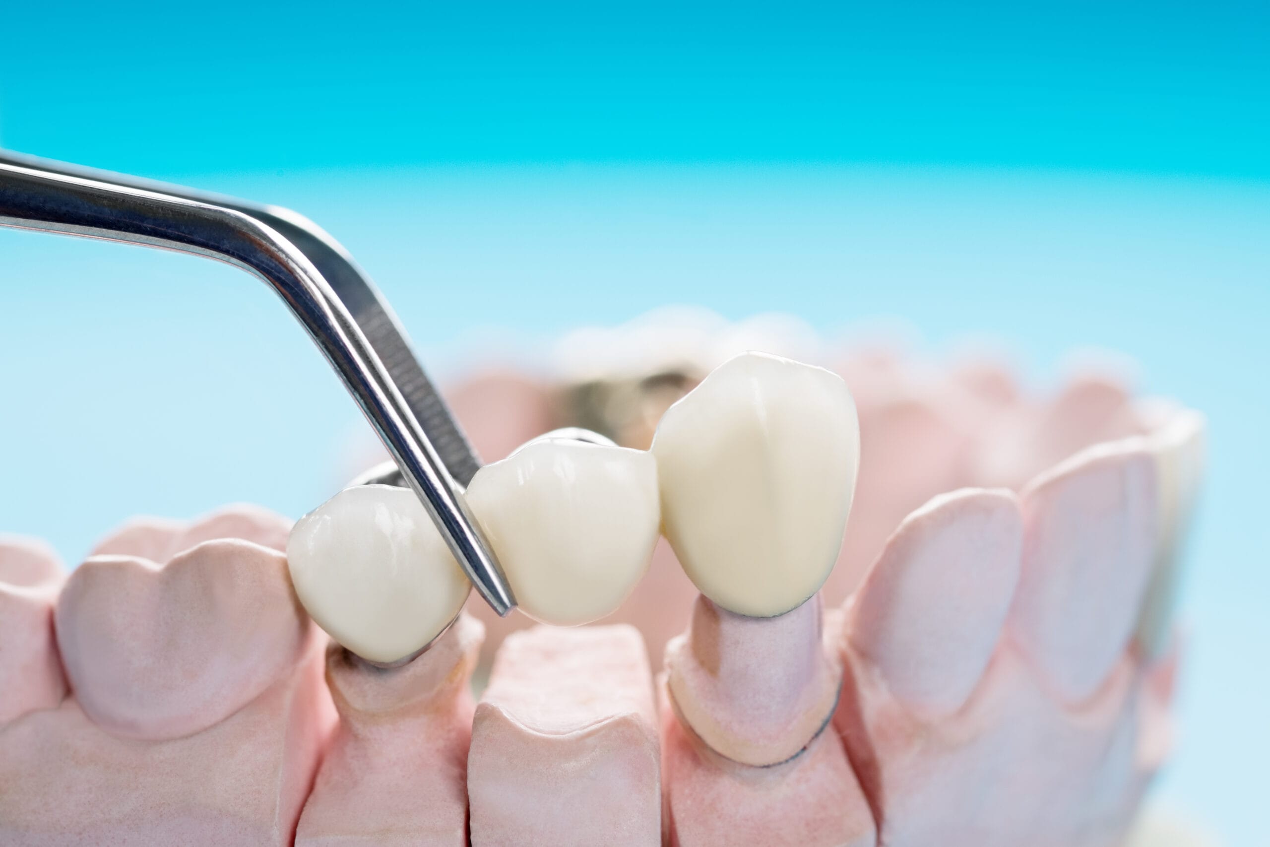 Prosthodontics And Crown And Bridge And Implantology scaled